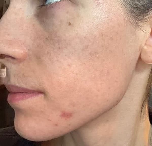 Sam, 29, Breakouts and texture, after