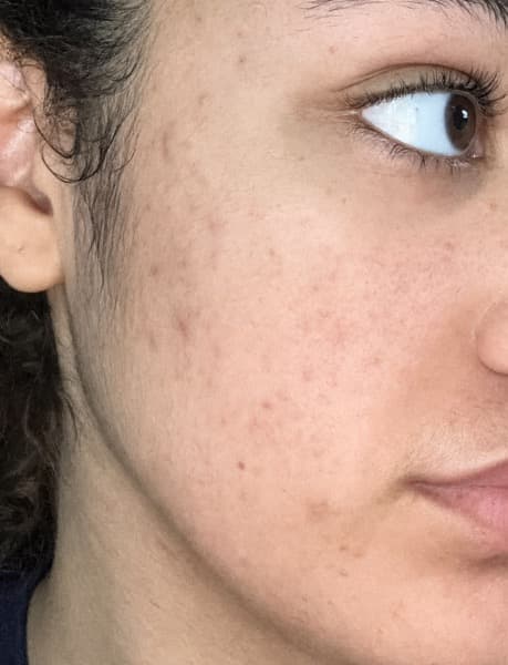 Zoey, 19, Acne and uneven tone, after